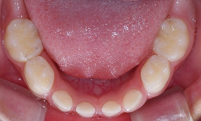 乳歯先欠前歯2本ー３.jpg