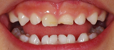 乳歯癒合歯左右４本－１.jpg