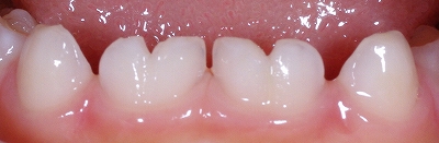 乳歯癒合歯左右４本ー２.jpg