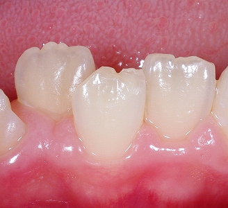 萌出直後の前歯の形態.jpg