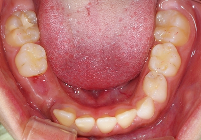 小児義歯１.jpg