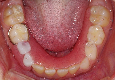 小児義歯２.jpg