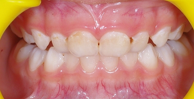 乳歯先欠前歯2本ー１.jpg