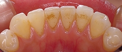 前歯のステイン３.jpg