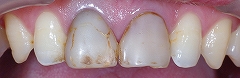 汚れた前歯を白く美しく－２.jpg