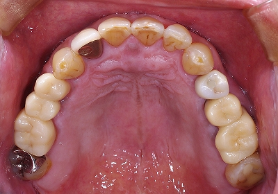 奥歯のブリッジをジルコニアに２.jpg