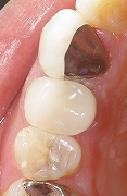 銀歯が取れたので白い歯に４.jpg