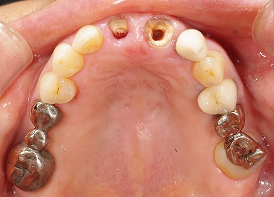 上顎前歯２本義歯１.jpg