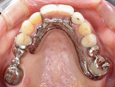 上顎前歯２本義歯２.jpg
