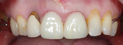 上顎前歯２本義歯３.jpg