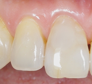 前歯の表層虫歯２.jpg