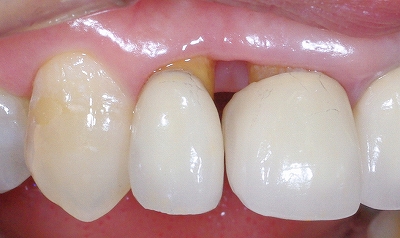 前歯歯肉退縮６－４.jpg