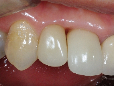 前歯歯肉退縮６－５.jpg