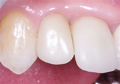前歯歯肉退縮６－６.jpg
