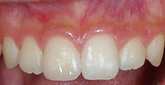 前歯先端が欠けて来院、即日治療２.jpg
