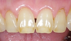 茶色い前歯を白く１.jpg