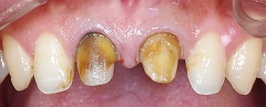 中まで変色した歯質ー２.jpg