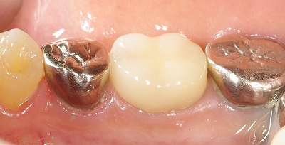 白い歯両隣黒い２.jpg