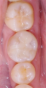 インレー二次カリエス１３，７ー３.jpg