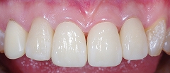 4前歯Ｅ－max-2.jpg