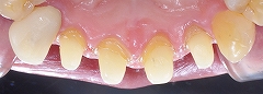 4前歯Ｅ－max-3.jpg