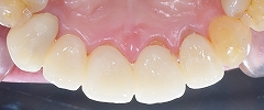 4前歯Ｅ－max-4.jpg