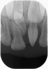 乳歯過剰歯２本１.jpg