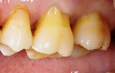 右上第二大臼歯歯根破折３－１.jpg