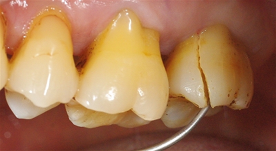右上第二大臼歯歯根破折３－２.jpg