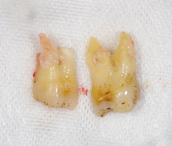 右上第二大臼歯歯根破折３－３.jpg
