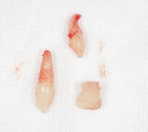 乳歯過剰歯２本２.jpg