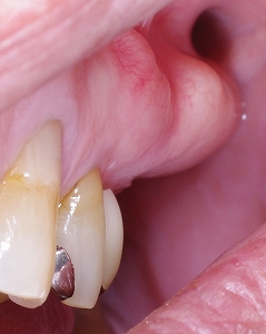 上顎臼歯部骨隆起１.jpg