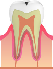 C1(虫歯の進行・エナメル質)