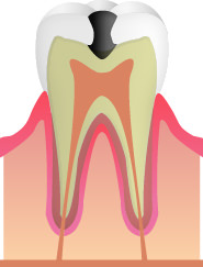 C1(虫歯の進行・エナメル質)