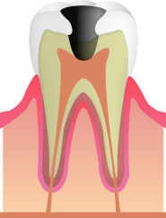 C3(虫歯の進行・神経まで達している)
