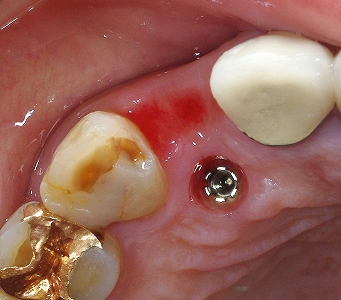 歯根破折をインプラントで修復４－３、.jpg