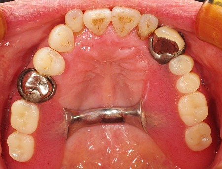 上顎義歯をインプラントに。１.jpg