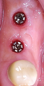 大臼歯２本欠損をインプラントで修復１.jpg