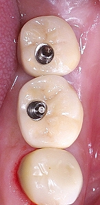 大臼歯２本欠損をインプラントで修復２.jpg