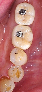 右下大臼歯インプラントスクリュー、、２.jpg