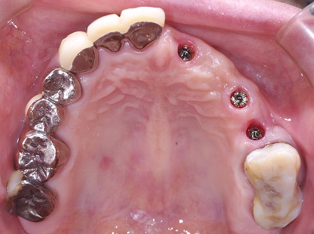 右上１，３，５インプラント術後全体セット前.jpg