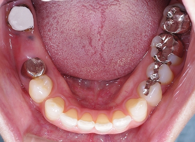 左下第一大臼歯インプラントスクリューリテインー１.jpg