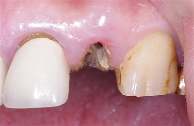 歯根破折をインプラントで修復４－１.jpg