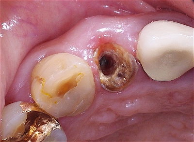 歯根破折をインプラントで修復４－２.jpg