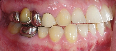 咬み合わせ原因前歯磨耗８－２.jpg