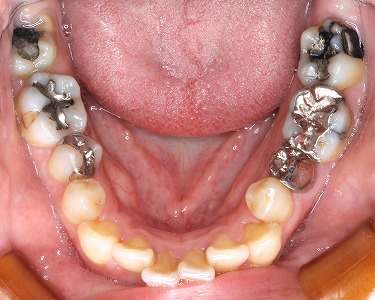 下顎臼歯を白くしたい多数歯１.jpg