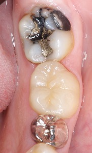 下顎臼歯を白くしたい多数歯３.jpg