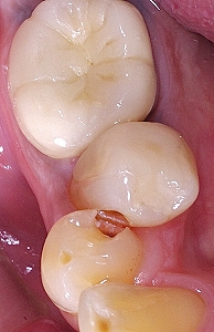 下顎小臼歯叢生による虫歯１.jpg