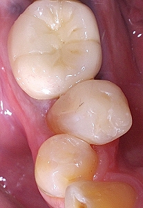 下顎小臼歯叢生による虫歯２.jpg