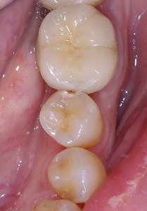 下顎第二小臼歯コンポジットレジン充填１.jpg